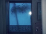 Doctor Sees Ultrasound as Complementary Test